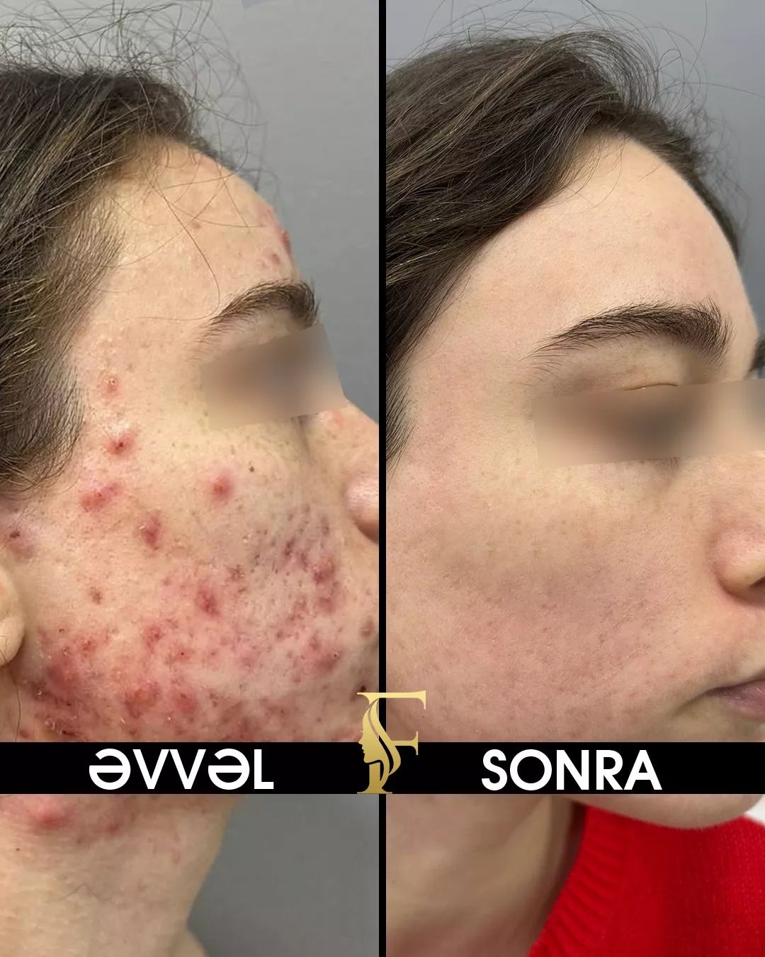 Sızanaq Müalicəsi